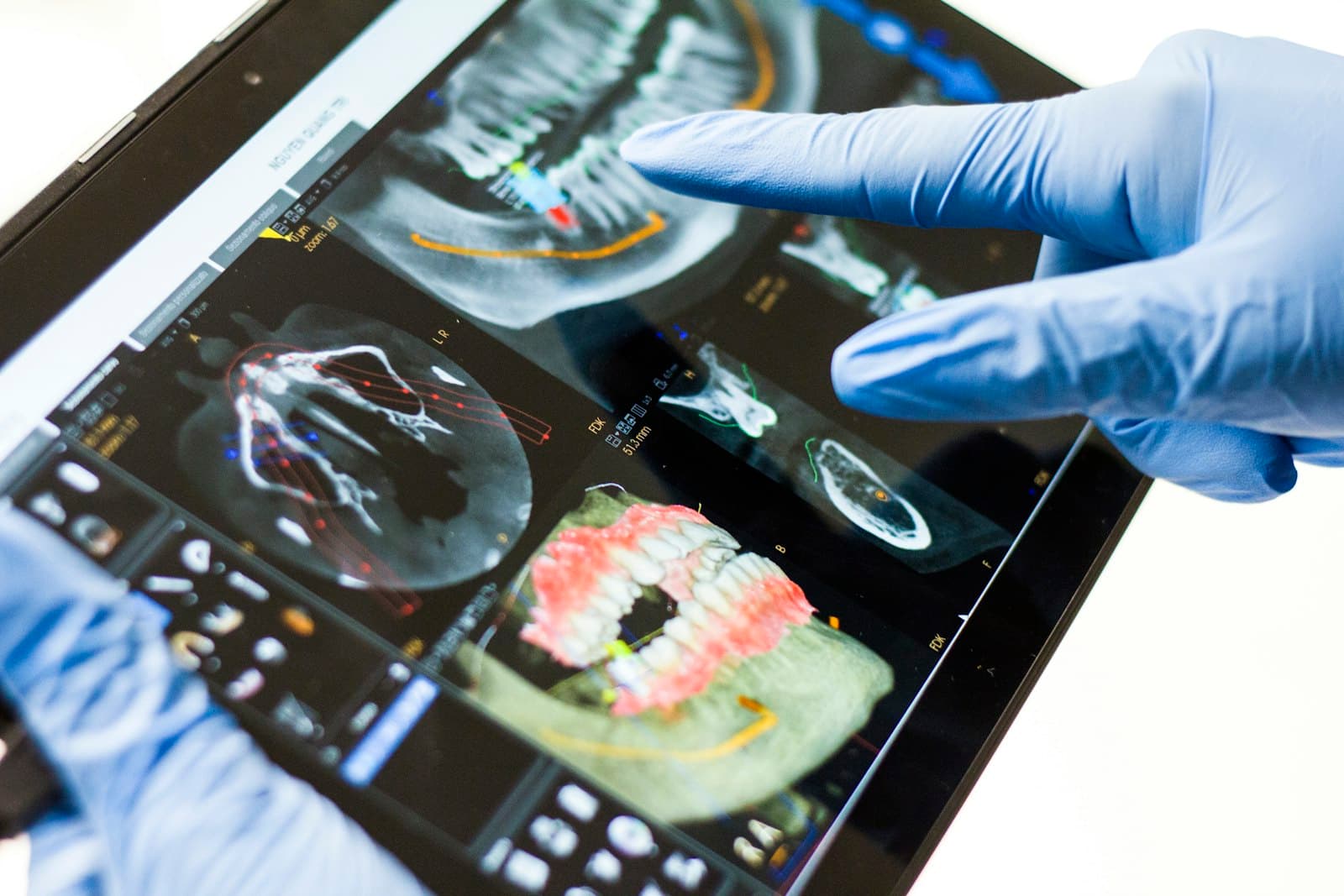 A gloved hand pointing to a 3D scan of the jaw on a tablet