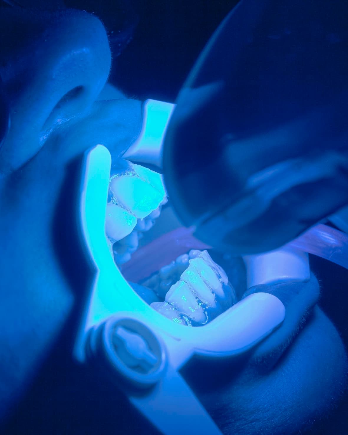 Chipped or Worn Front Teeth treatments at Johns Creek Family Dentistry