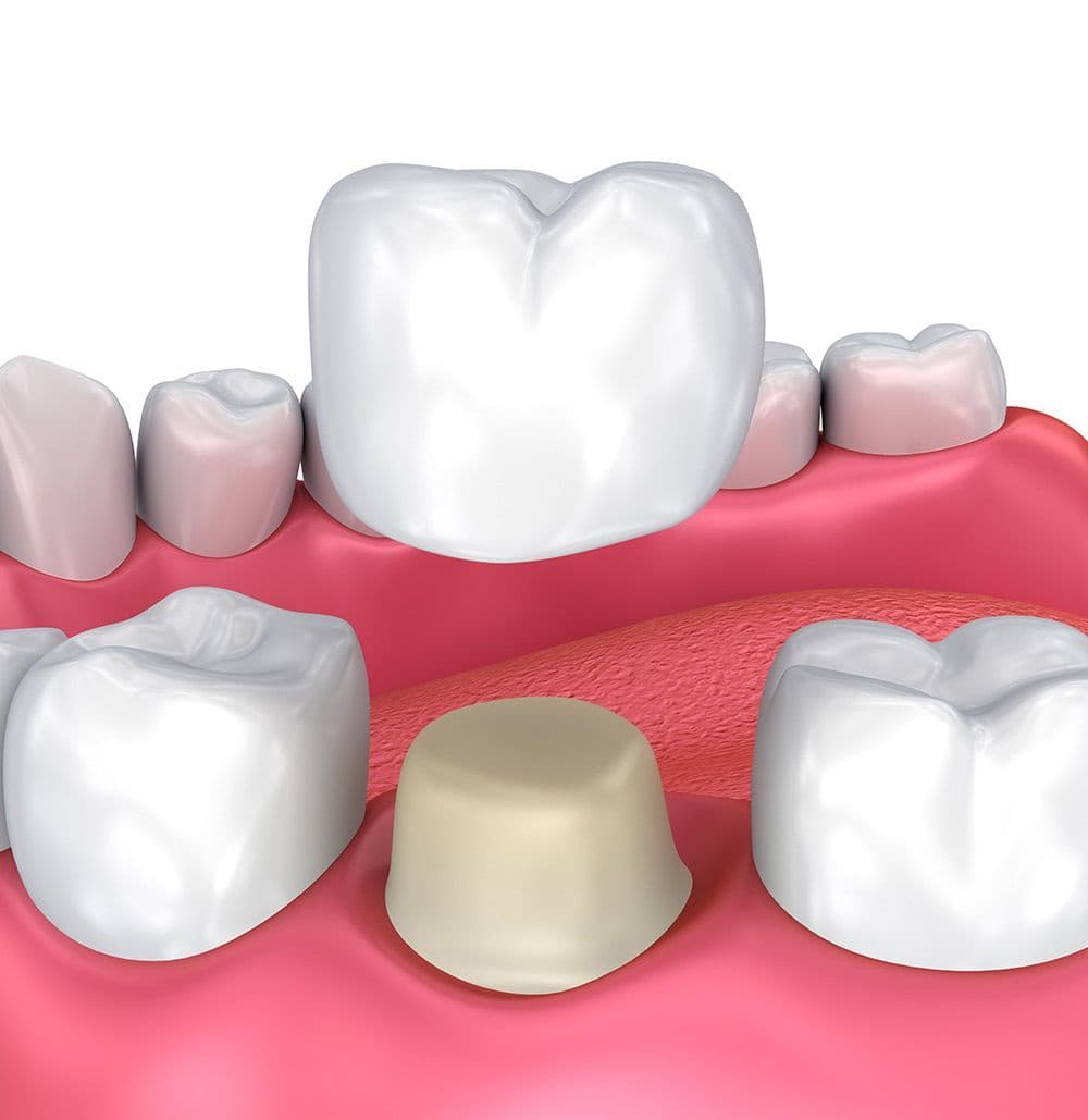 Cracked or Broken Tooth treatments at Johns Creek Family Dentistry